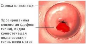 Sangerarea eroziune de col uterin