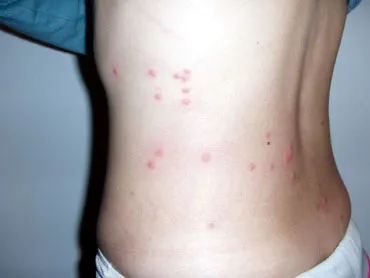 Blood-suge insecte in pat - care te musca pe timp de noapte