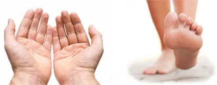 psoriazis imagine palmoplantar, tratamentul de remedii populare