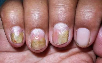 Lada plantar psoriazis simptome, fotografii, recenzii și tratament (simptome) Lada simptome plantară psoriazis, fotografii, recenzii și tratament