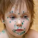 Tratamentul de acnee rozacee pe fața de remedii populare, medicina tradițională (populară) Tratamentul de acnee rozacee pe fața de atac folk, medicina tradițională