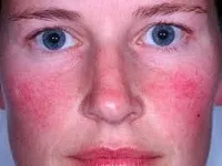 Tratamentul de acnee rozacee pe fața de remedii populare, medicina tradițională (tratamentul acneei rozacee remedii populare boli de piele faciale pentru a trata simptomele bolii măștilor) Tratamentul de acnee rozacee pe fața de atac folk, medicina tradițională