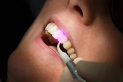 Stomatologie cu laser - caracteristici, beneficii, indicații (prestații) Stomatologie cu laser - caracteristici, beneficii, indicații