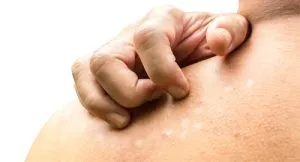 Tratamentul Tinea versicolor în casa unei persoane - un colorat remedii populare (condiții) Tratamentul Tinea versicolor în casa unei persoane - din căile de atac populare colorate