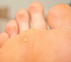 Tratamentul shipigi pe picioare medicina traditionala sau remedii populare
