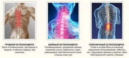 Tratamentul osteocondrozei în căile de atac acasă populare