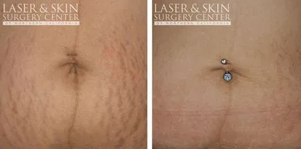 Ablație cu laser tehnici și tipuri de lasere întindere, efectul (întindere) tehnici de ablație cu laser si tipuri de lasere elastice, efectul