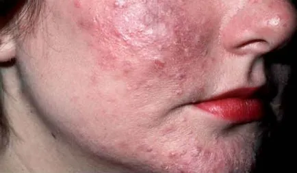 remedii populare rozacee Tratament