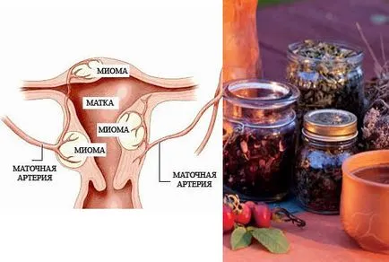 Tratamentul pe bază de plante de fibrom uterin, medicina populara pentru fibrom, rețete