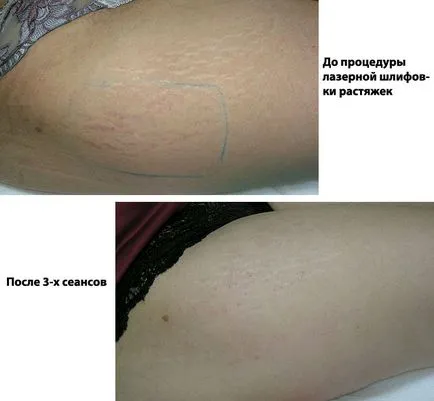 Laser ablația tehnici și tipuri de întindere de lasere, efectul (eliminare) tehnici de ablație cu laser si tipuri de lasere elastice, efectul