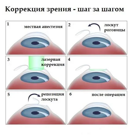 corectarea vederii cu laser - clinica Feodorov (Fedorov) corectarea vederii cu laser - clinica Fedorova