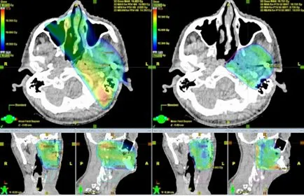 Radioterapia in oncologie pentru tratamentul cancerului și a consecințelor sale (Oncologie) Radioterapia in oncologie pentru tratamentul cancerului și a consecințelor sale