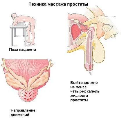 Prostată Masajul este eficient în tratamentul prostatitei