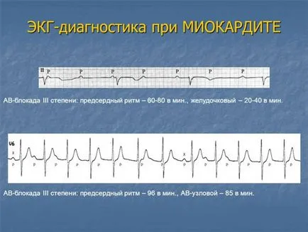 inima Miocardita - ce este, provoacă, consecințe, ICD-10