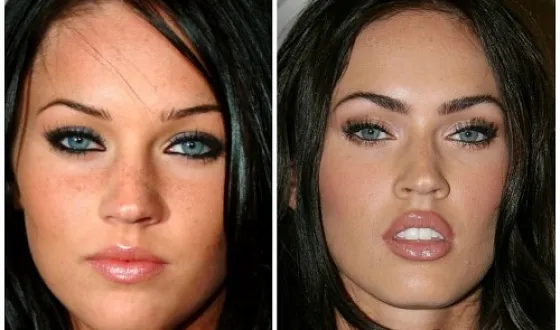 Megan fox, înainte și după fotografii și video de chirurgie plastica