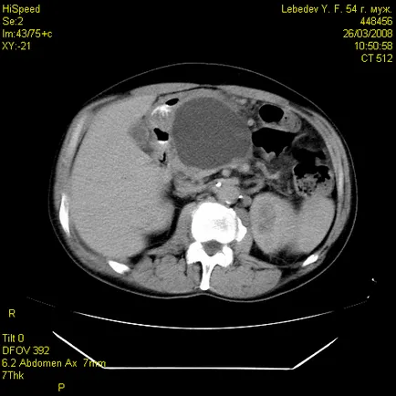 RMN si CT (Imagistica prin rezonanta magnetica si tomografie de calculator) pancreas pancreatită (prostată) RMN si CT (imagistica prin rezonanta magnetica si tomografie de calculator) pancreasului în pancreatita