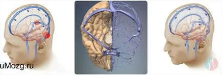 Violarea cerebrale simptome de scurgere venoase, tratament, medicamente pentru distsirkulyatsii (cap) Violarea cerebrale venoase simptome de evacuare, tratament, medicamente pentru distsirkulyatsii