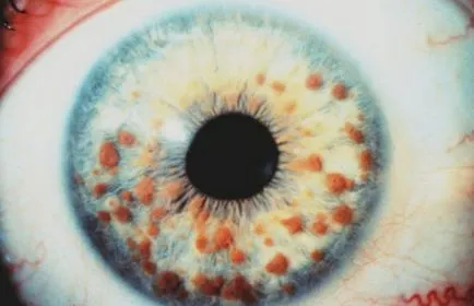 nev coroidian și fotografie iris ochi, pericol, diagnostic, tratament, prognostic