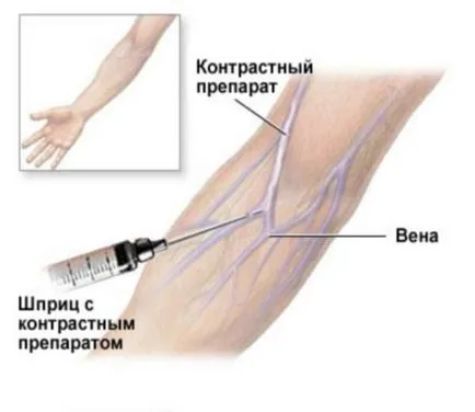 Opinie, urografie excretor renală și mediu de contrast intravenos cu copii și (pregătire pentru urografie renală, cu un contrast) Opinie, urografie excretor renală și mediu de contrast intravenos cu copii și