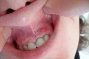 obraz Umflarea după dinte ce să facă, cum să eliminați umflarea