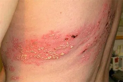 Infecțiile oportuniste - ceea ce este, cauze și tipuri