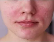 Albirea masca la domiciliu, un efect rapid de pete de pigment