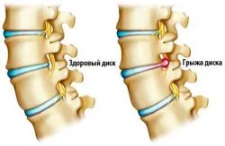Osteocondrozei departamentului de col uterin de umăr tratament și cauza (a umărului) Osteocondrozei departamentului de col uterin de umăr tratament și cauze