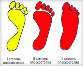 pantofi ortopedice pentru femei (vara, iarna si la domiciliu) modul de a alege când și valgus