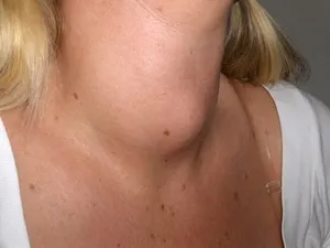 Senzație de un nod în gât de ce poate fi pentru a scăpa de nodul la înghițire, cauzele și