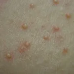 erupții Diferențele piele în boli infecțioase, foto, video