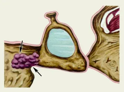 Otoscleroză ce este, simptome si tratament fara chirurgie remedii populare