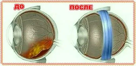 Cauzele Dezlipirea de retina si de un tratament mai bun (retina) dezlipire de retina Cauzele și un tratament mai bun