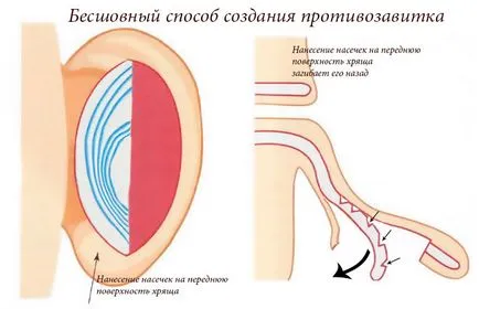 Otoplastia (urechi de plastic) - ce este, înainte și după fotografii, comentarii, pret