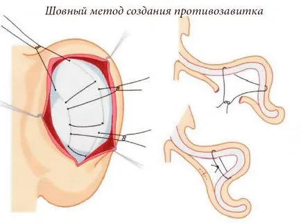 Otoplastia (urechi de plastic) - ce este, înainte și după fotografii, comentarii, pret