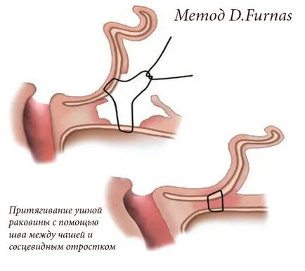 Otoplastia (urechi de plastic) - ce este, înainte și după fotografii, comentarii, pret