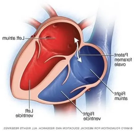 brevet foramen ovale în inima unui copil la sugari și nou-născut gaura, inima