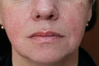 Panthenol acnee - comentarii, crema ajuta daca spray, facial, crema, pete