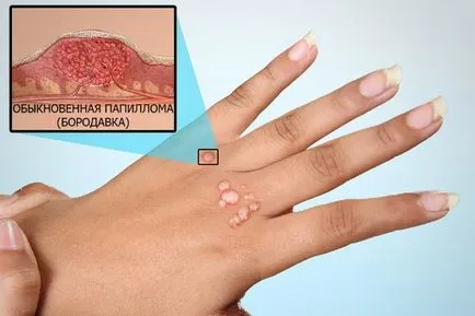 Papiloma, tratament și cauzele privind modul de a trata virusul HPV la om (papilom) Papiloma, tratament și cauzele privind modul de a trata virusul HPV la om