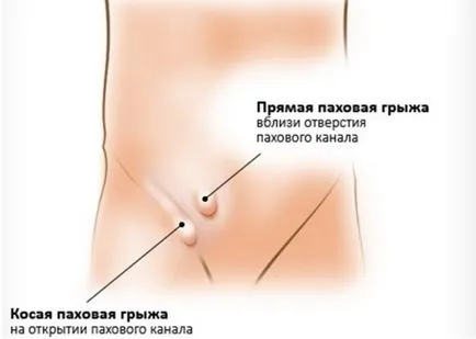 hernie inghinală cauze, tratamentul și prevenirea