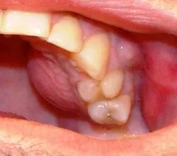 Periostita maxilarului - tratamentul inflamației periostului remedii populare dinte (tratament) Periostita maxilarului - tratamentul inflamație a remediilor populare dentare periostului
