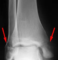 Fractura a tibiei - cauze, simptome, diagnostic si tratament (impune o atelă ipsos) Fracturarea tibiei - cauze, simptome, diagnostic și tratament