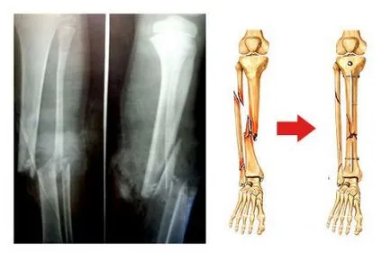 Fractura a tibiei cu deplasare și fără (deschis, închis) și primul ajutor