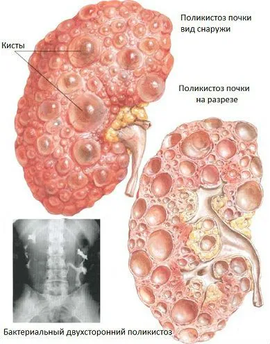 De ce doare rinichii la om, provoacă dureri în zona rinichilor (persoană) De ce doare rinichii la om, provoacă dureri în zona rinichilor