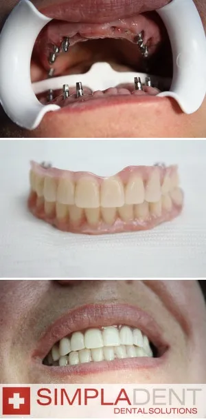 protezele complete, protetica edentulous