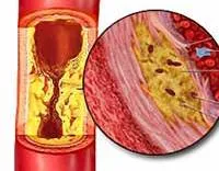 Cauzele tensiunii arteriale crescute mai mici, tratament inferior (presiune) Creșterea tensiunii arteriale mai mici cauze, tratament, cum de a reduce