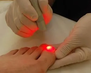 Avantajele tratamentului cu laser a unghiilor incarnate (incarnata) Avantajele tratamentului cu laser a unghiilor incarnate