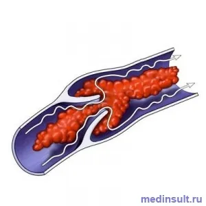 prevestitori de accident vascular cerebral la bărbați și femei