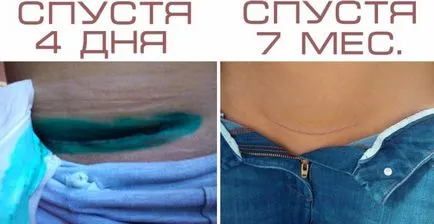 Corectă cusătură de tratament ingrijirilor dupa cezariana