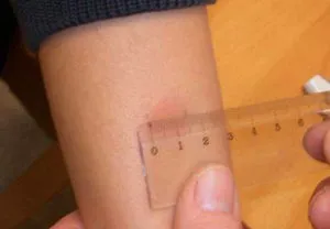 Vaccinarea împotriva tetanosului pentru adulți atunci când o fac, efecte secundare, tipuri de vaccinuri