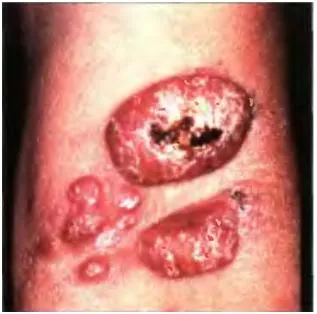 cancer de piele, melanomul - cauze, simptome si tratament